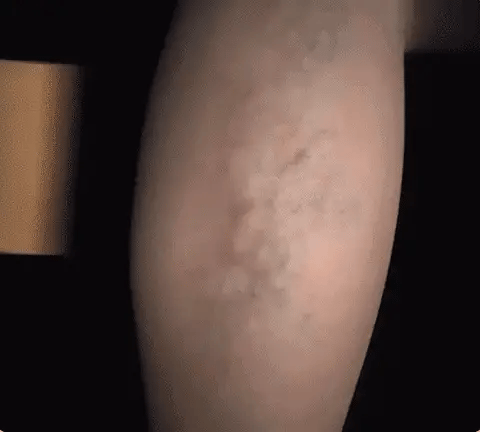 Caneta laser removedora de acne espinhas