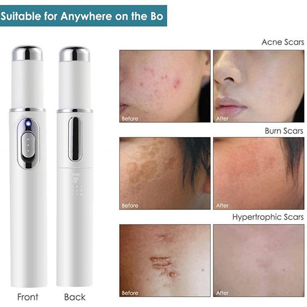 Caneta laser removedora de acne espinhas